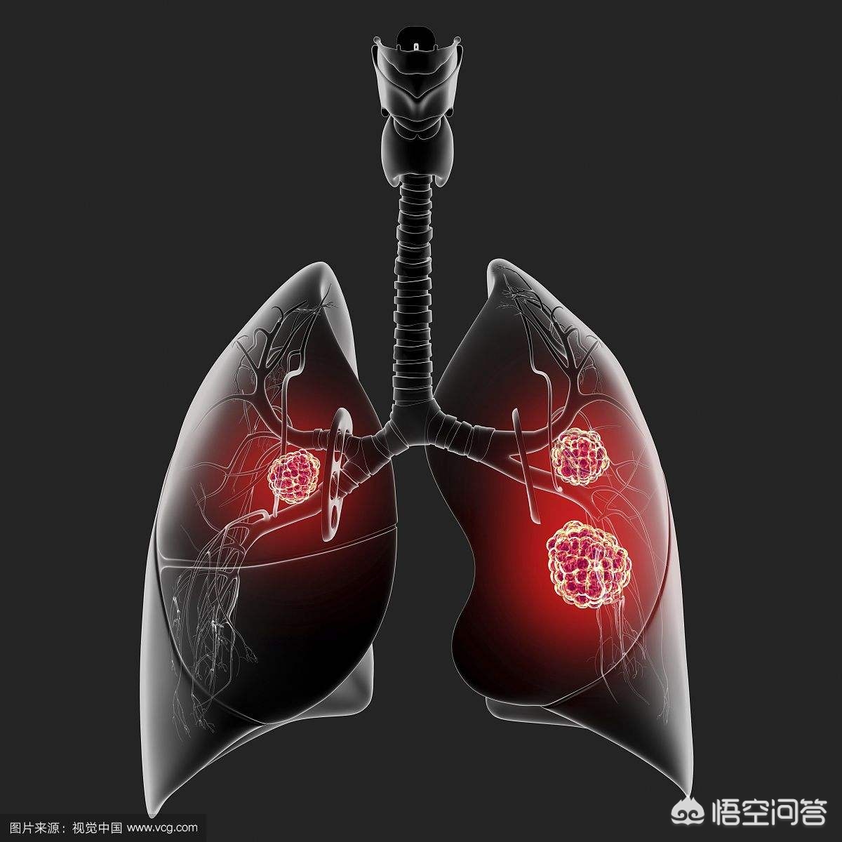 今日科普一下！干咳两个月查出肺癌,百科词条爱好_2024最新更新