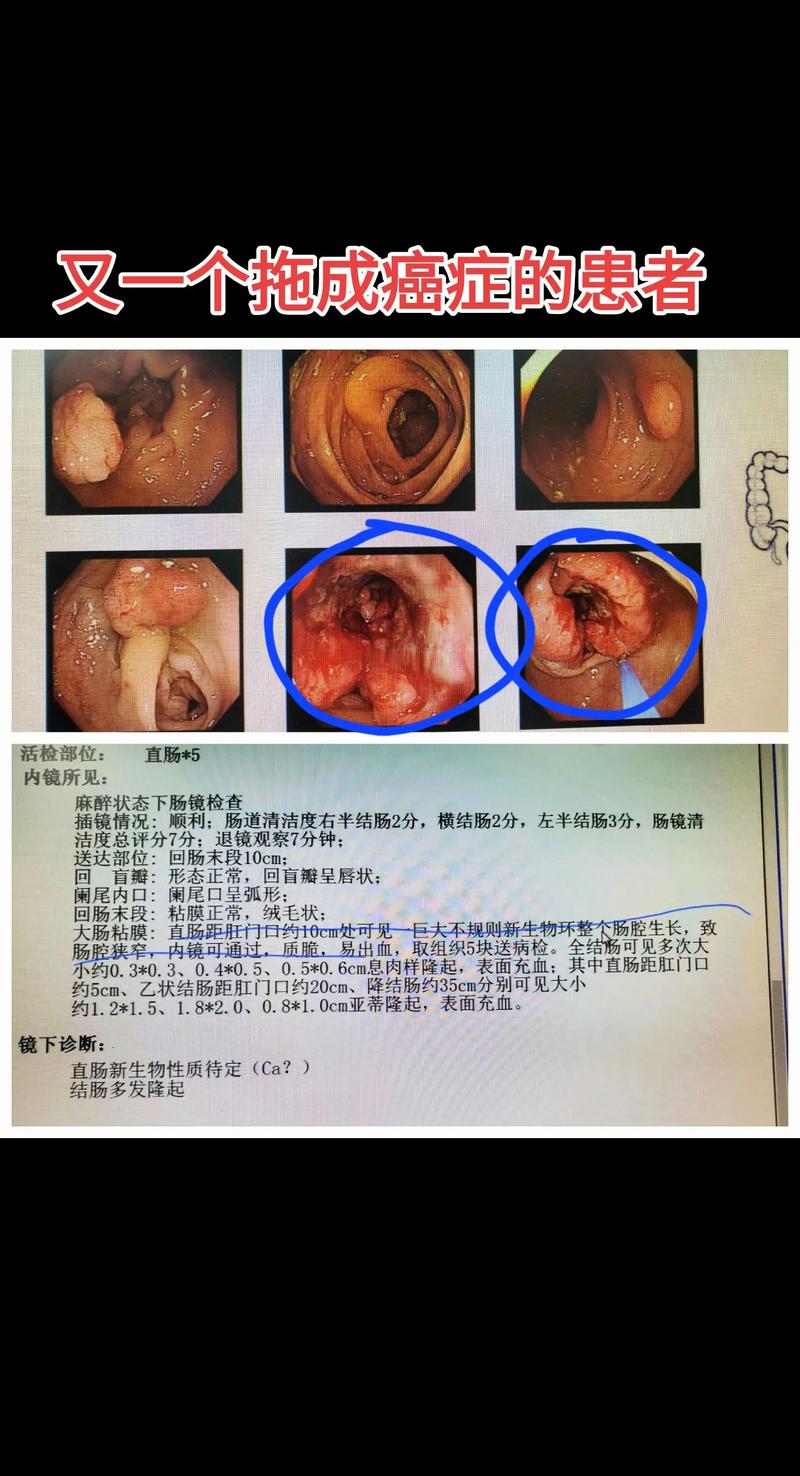 今日科普一下！腹泻几天确诊结肠癌,百科词条爱好_2024最新更新